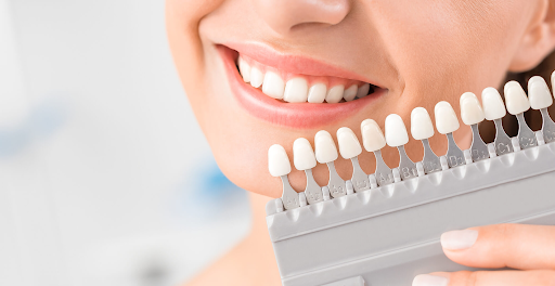 Dental Veneers Cost: Investing in a Radiant Smile