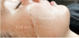 Top Benefits of Dermaplaning in Houston for Smooth Skin